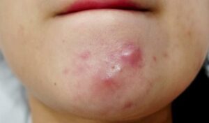 Cách trị mụn bọc sưng đỏ (Nguồn: Internet)