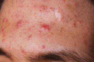 Mụn viêm là gì? (Nguồn: Interent)