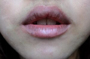 Tình trạng xăm môi 1 tháng vẫn thâm kéo dài (Nguồn: Internet)